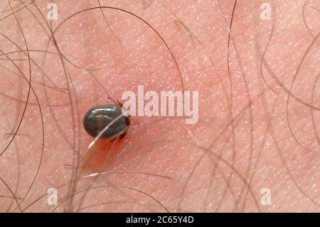 removing tick (Ixodes ricinus) with pincers. European castor bean tick, European sheep tick on skin, Germany Stock Photo