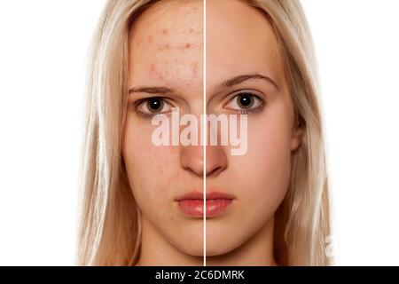 Comparative portrait of female face, before and after cosmetic treatment Stock Photo