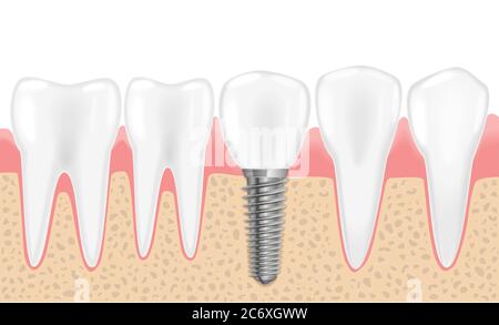Healthy teeth and dental implant. Realistic vector illustration of tooth medical dentistry. Human teeth dental implantation Stock Vector