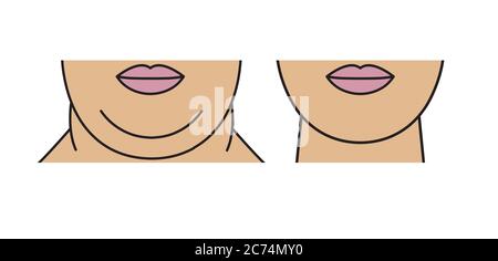 Double chin, restoration of facial contours with aid liposuction, weight loss and exercise. Rejuvenation of female face. Stock Vector