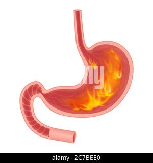 Realistic medical illustration of pyrosis stomach isolated. Fire disorder inside stomach Stock Vector