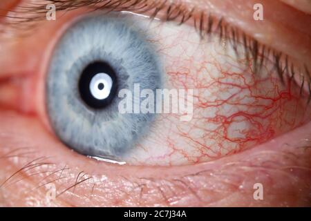 Irritated male blue eye full with capillar net Stock Photo