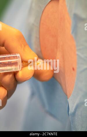 Spinal anesthesia, implementation Stock Photo