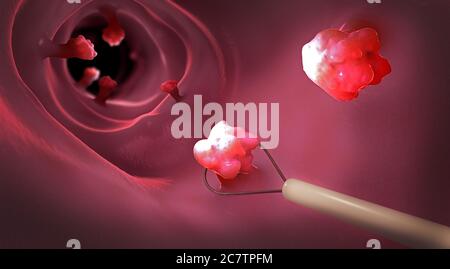 Removal of a colonic polyp with a electrical wire loop during a colonoscopy - 3d illustration Stock Photo