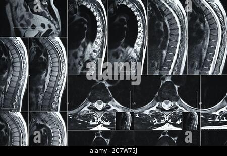 Close up magnetic resonance imaging or computed tomography scan of human lumbar spine Stock Photo