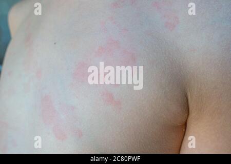 A child has broken out in hives, a raised angry red rash as a result of ...