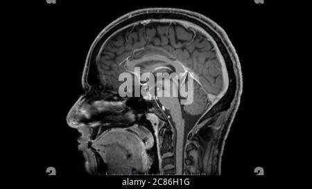 Magnetic resonance  images of the brain (MRI brain) sagittal post contrast sequence in cine mode showing normal anatomy Stock Photo