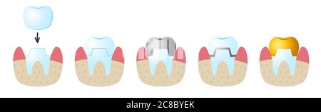 Icons on the dental Theme. Service installation of a ceramic crown. As well as a metal and gold crown on the tooth. Set icons flat style. Stock Vector