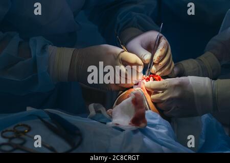 Close-up shot of surgeon and his assistant performing cosmetic surgery in hospital operating room. Doctor holding surgical instruments during medical Stock Photo
