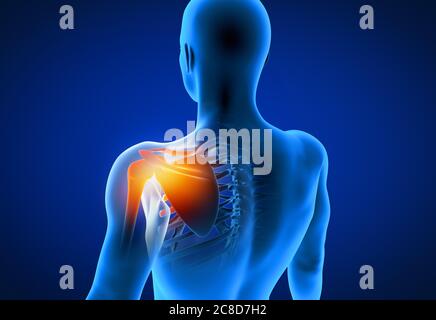 3d rendered illustration of a painful shoulder. Stock Photo