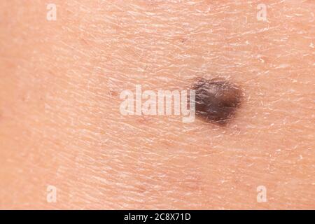 Mole birthmark nevus macro photo on human skin. Close up Stock Photo