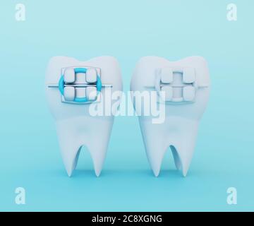 3d render of teeth with ceramic and metal braces in gums isolated over ...
