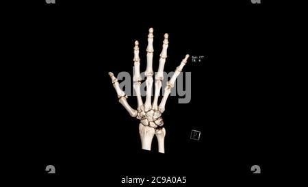 Computed Tomography Volume Rendering examination of the hand showing normal anatomy ( CT VR hand). 3D rendering Stock Photo