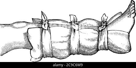 https://l450v.alamy.com/450v/2c9c6m9/a-typical-representation-to-show-how-a-pillow-an-inside-coat-a-sweater-or-a-blanket-may-be-used-as-a-temporary-splint-on-a-broken-leg-vintage-line-2c9c6m9.jpg