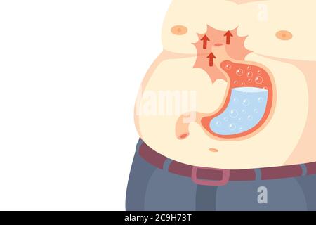 Gastritis is caused by several causes. Gastritis is common with all ages. Stock Vector