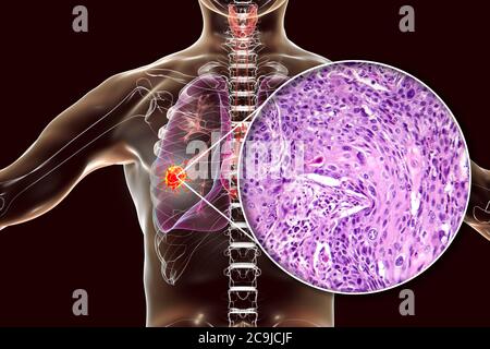 Computer illustration and light micrograph of squamous cell carcinoma of the lung. Stock Photo