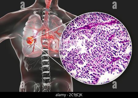 Lung cancer. Computer illustration and light micrograph of small cell lung cancer. Stock Photo