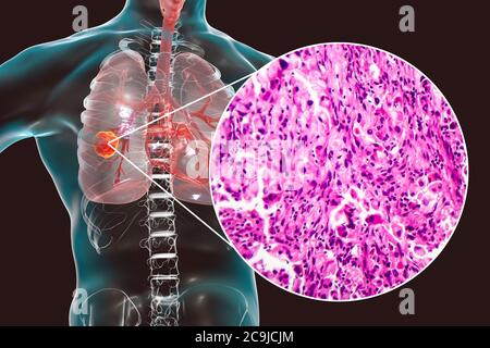 Lung cancer, computer illustration and light micrograph. Stock Photo