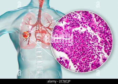 Lung cancer, computer illustration and light micrograph. Stock Photo