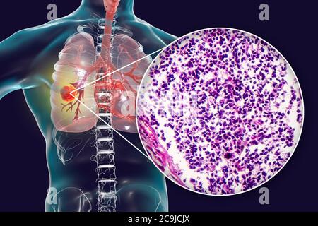 Lung cancer. Computer illustration and light micrograph of small cell lung cancer. Stock Photo