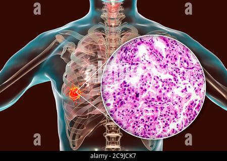 Lung cancer, computer illustration and light micrograph. Stock Photo