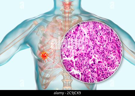 Lung cancer, computer illustration and light micrograph. Stock Photo