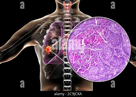 Computer illustration and light micrograph of squamous cell carcinoma of the lung. Stock Photo