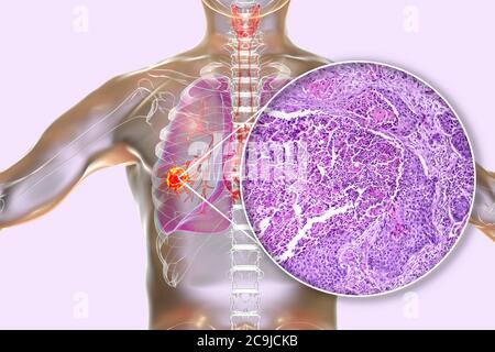 Computer illustration and light micrograph of squamous cell carcinoma of the lung. Stock Photo