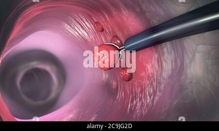 Polyp removal, illustration. Removal of a colonic polyp with an electrical wire loop during a colonoscopy. Stock Photo