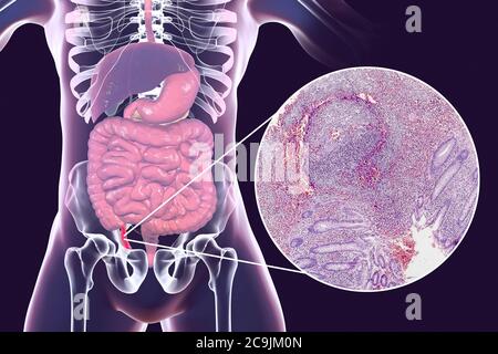 Chronic appendicitis, computer illustration and light micrograph. Illustration of a human appendix that is red and inflamed in appendicitis. The appen Stock Photo