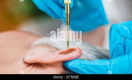 Auriculotherapy, or auricular treatment on human ear with flexible massage brass ear pen, close up. Acupuncture pressure on ear seed sticker. Stock Photo