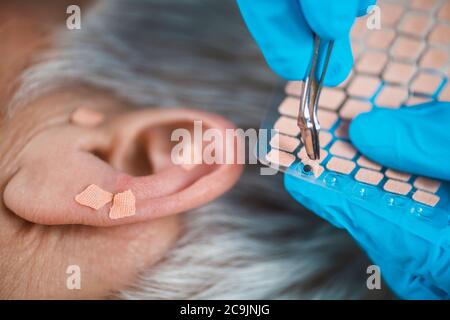 Auriculotherapy, or auricular treatment on human ear, close up. Therapist's hand applying acupuncture ear seed sticker with tweezers. Stock Photo