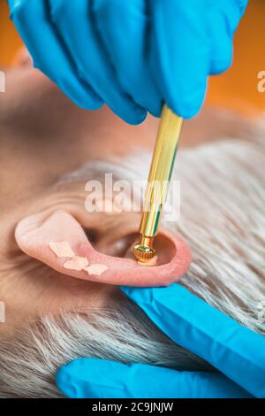 Auriculotherapy, or auricular treatment on human ear, close up. Therapist's hand applying acupuncture ear seed sticker with tweezers. Stock Photo