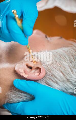 Auriculotherapy, or auricular treatment on human ear, close up. Therapist's hand applying acupuncture ear seed sticker with tweezers. Stock Photo