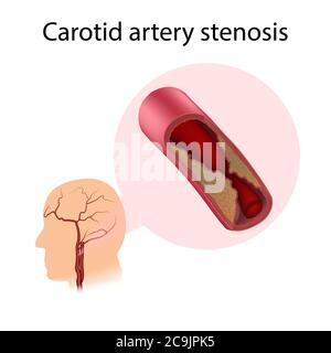 Illustration of carotid artery stenosis. The abnormal narrowing of this ...