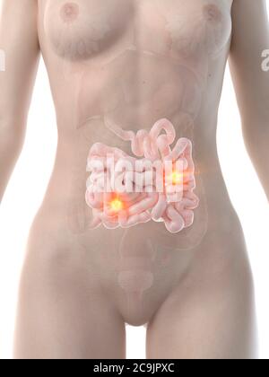 Small intestine cancer, conceptual computer illustration. Stock Photo