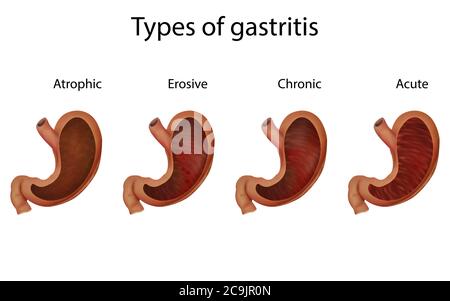 Chronic and acute gastritis, illustration Stock Photo - Alamy