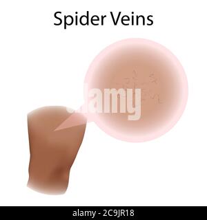 Spider veins, illustration. Stock Photo