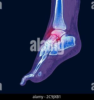 Fractured ankle bone. Coloured computed tomography (CT) scan of the bones of the foot and ankle of a 23-year-old woman with a comminuted (splintered) Stock Photo