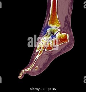 Fractured ankle bone. Coloured computed tomography (CT) scan of the bones of the foot and ankle of a 23-year-old woman with a comminuted (splintered) Stock Photo