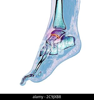 Fractured ankle bone. Coloured computed tomography (CT) scan of the bones of the foot and ankle of a 23-year-old woman with a comminuted (splintered) Stock Photo