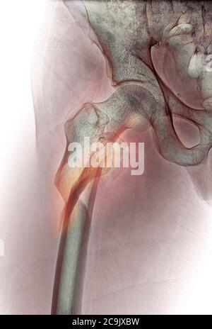Hip fracture. Coloured frontal X-ray of the right hip of a 53-year-old man, showing a comminuted (splintered) fracture of the neck of the femur (centr Stock Photo