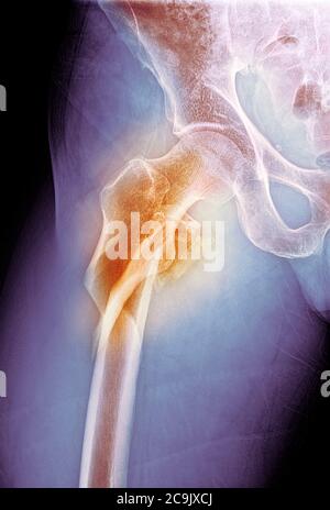 Hip fracture. Coloured frontal X-ray of the right hip of a 53-year-old man, showing a comminuted (splintered) fracture of the neck of the femur (centr Stock Photo