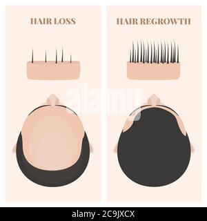 Man before and after hair transplantation, illustration. Stock Photo