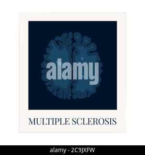 Brain affected by multiple sclerosis, illustration. Stock Photo