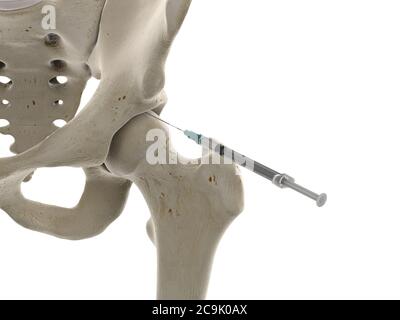 Hip joint injection, illustration. Stock Photo