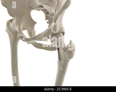 Hip joint injection, illustration. Stock Photo