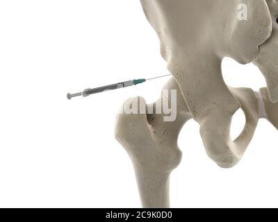 Hip joint injection, illustration. Stock Photo