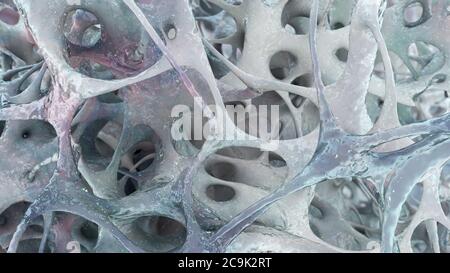 Illustration of bone structure affected by osteoporosis. Thinning of ...