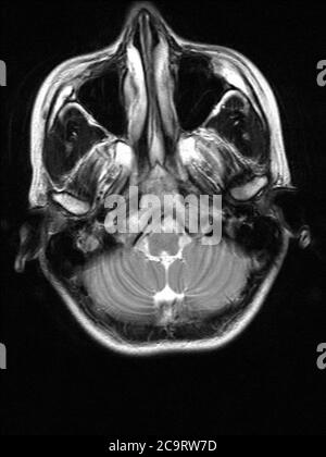 MRI, magnetic resonance imaging of a healthy brain of a woman around 22 years of age Stock Photo